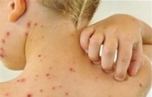 Osasco e Barueri já têm 30 casos de sarampo